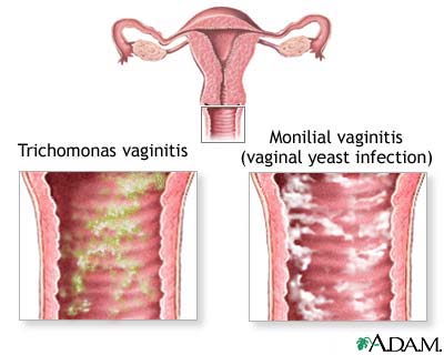 Causes of vaginal itching Causes of vaginal itching