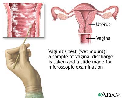 The wet mount vaginitis test The wet mount vaginitis test