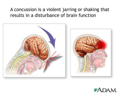 Concussion Concussion
