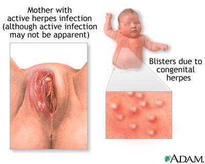 Congenital herpes Congenital herpes