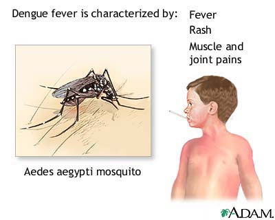 Dengue fever Dengue fever