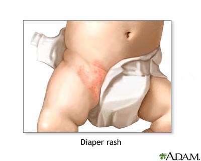 Diaper rash Diaper rash