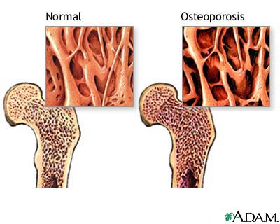 Osteoporosis Osteoporosis