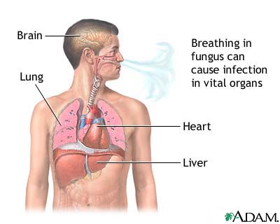 Disseminated coccidioidomycosis Disseminated coccidioidomycosis