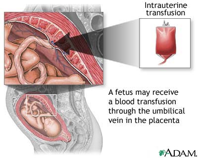 Intrauterine transfusion Intrauterine transfusion