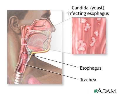 Candidal esophagitis Candidal esophagitis