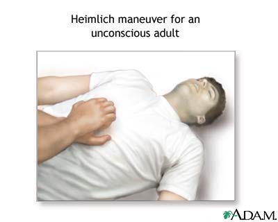 Unconscious Heimlich Unconscious Heimlich