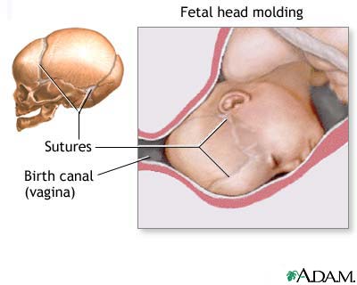 Fetal head molding Fetal head molding