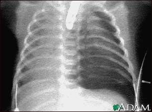 Pneumothorax - chest X-ray Pneumothorax - chest X-ray