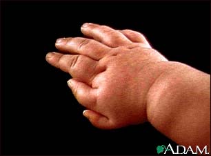 Polydactyly - an infant's hand Polydactyly - an infant's hand