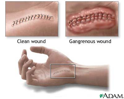 Gas gangrene Gas gangrene