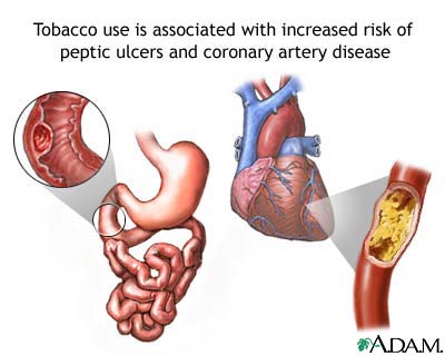 Tobacco and vascular disease Tobacco and vascular disease