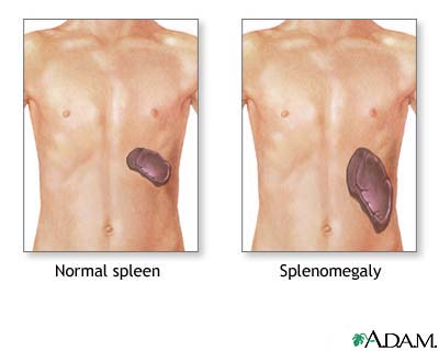 Splenomegaly Splenomegaly