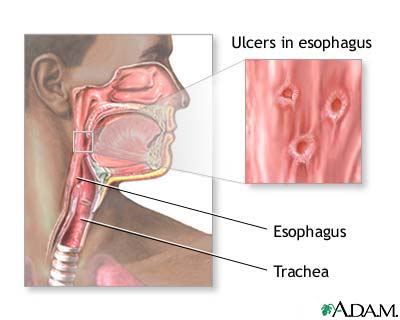 Herpetic esophagitis Herpetic esophagitis