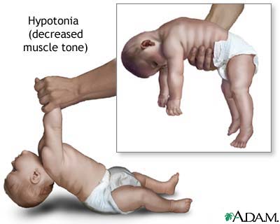 Hypotonia Hypotonia