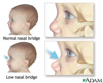 Low nasal bridge Low nasal bridge