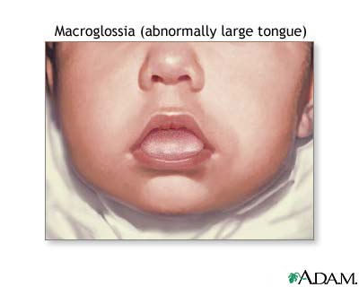 Macroglossia Macroglossia