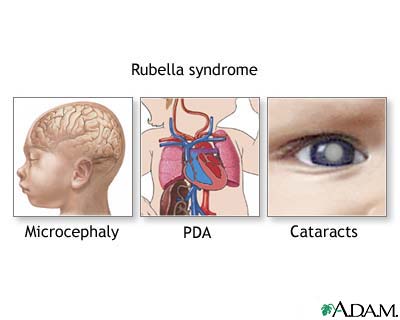 Rubella Syndrome Rubella Syndrome