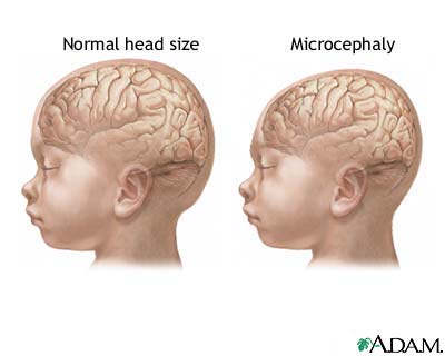 Microcephaly Microcephaly