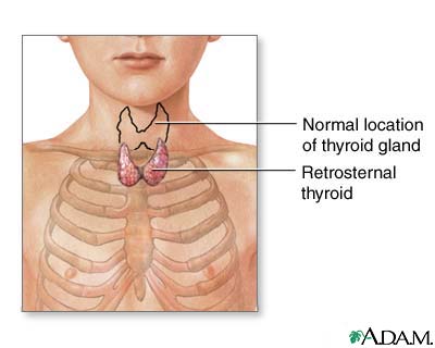 Retrosternal thyroid Retrosternal thyroid
