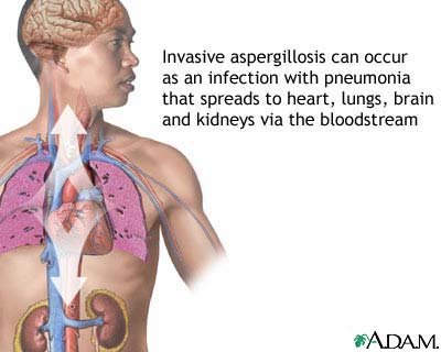 Pulmonary aspergillosis Pulmonary aspergillosis