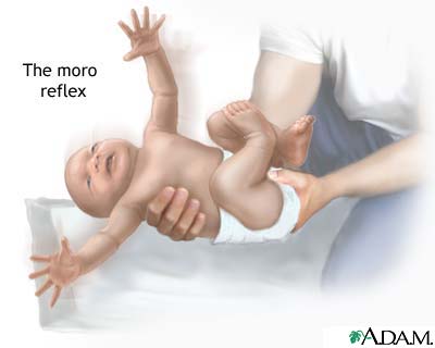Moro reflex Moro reflex