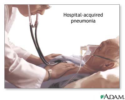 Hospital-acquired pneumonia Hospital-acquired pneumonia