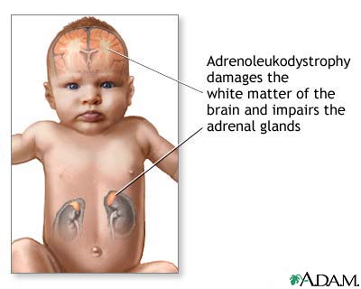 Neonatal adrenoleukodystrophy Neonatal adrenoleukodystrophy