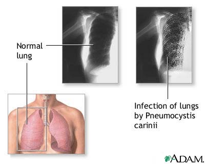 Pneumocystosis Pneumocystosis