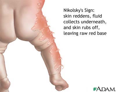 Nikolsky's sign Nikolsky's sign