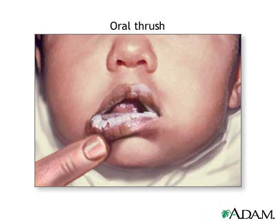 Oral thrush Oral thrush
