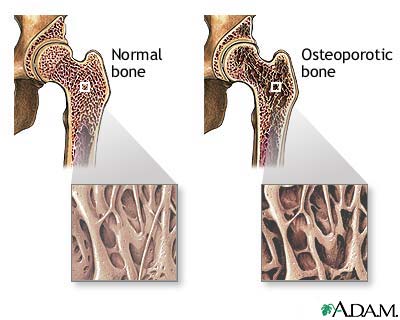 Osteoporosis Osteoporosis
