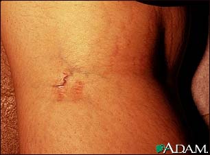 Striae in the popliteal fossa Striae in the popliteal fossa