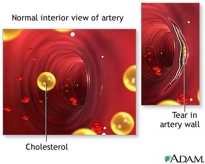 Arterial tear in internal carotid artery Arterial tear in internal carotid artery