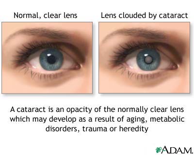 Cataract Cataract