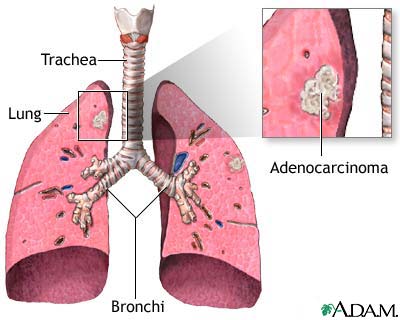 Adenocarcinoma Adenocarcinoma