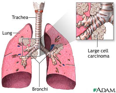 Large cell carcinoma Large cell carcinoma