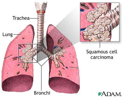 Squamous cell carcinoma Squamous cell carcinoma