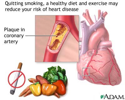 Prevention of heart disease Prevention of heart disease