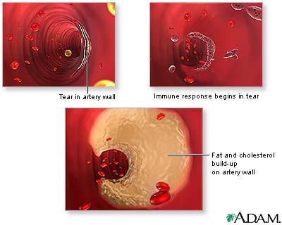 Arterial plaque build-up Arterial plaque build-up