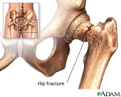 Hip fracture Hip fracture