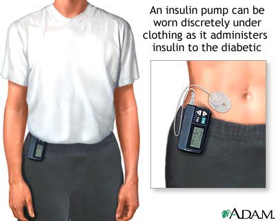 Insulin pump Insulin pump