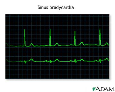 Bradycardia Bradycardia