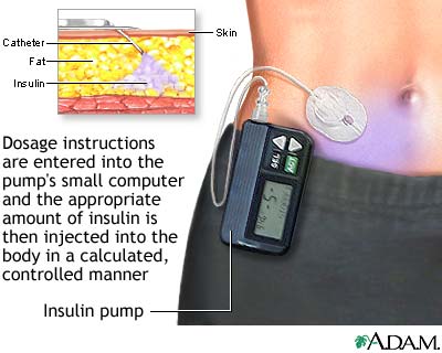 Insulin pump Insulin pump