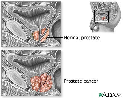 Prostate cancer Prostate cancer