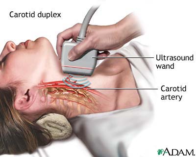 Carotid duplex Carotid duplex