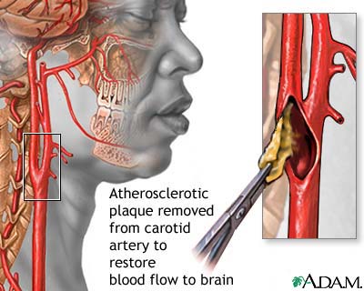 Endarterectomy Endarterectomy