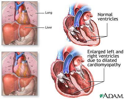 Alcoholic cardiomyopathy Alcoholic cardiomyopathy