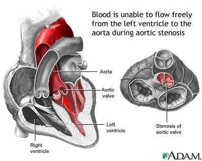 Aortic stenosis Aortic stenosis