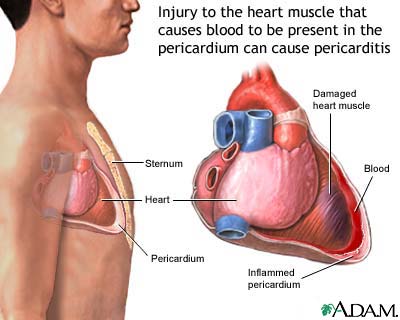 Post-MI pericarditis Post-MI pericarditis